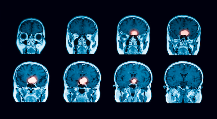 meningioma and birth depo provera